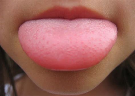 Swollen Or Inflamed Taste Buds On Tongue Causes And Remedies