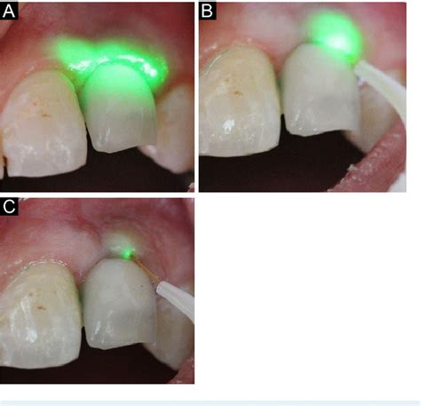 Figure 1 From Evaluation Of Effectiveness Of Photodynamic Therapy With