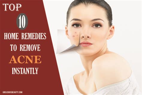 How To Remove Acne Instantly Top 10 Home Remedies