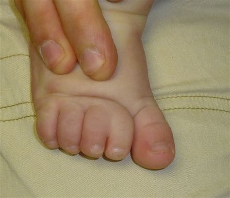 Toe Syndactyly More Thoughts Congenital Hand And Arm Differences