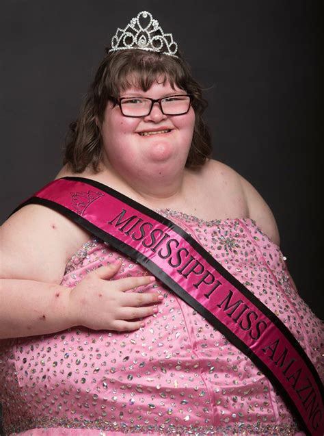 380 Pound Beauty Queen Brings Attention To Rare Disorder That Causes