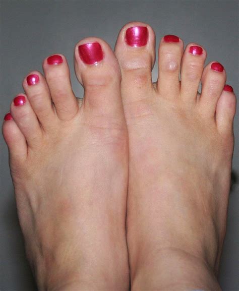 Physical Therapy After Hammertoe Surgery Tia Brengettey