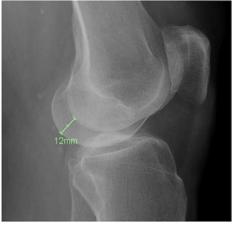 Figure 1 From Large Osteophyte Removal From The Posterior Femoral