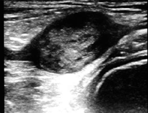 Figure 2 From Common Peroneal Nerve Schwannoma A Rare Cause Of