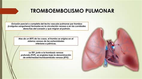 Trombosis Pulmonar Introduccion A La Embolia Pulmonar Thrombosis The