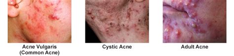 Acne Treatments Orlando Associates In Dermatology