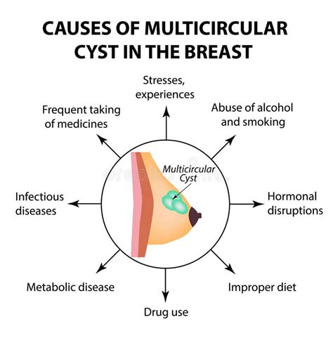 The Causes Of Multicameral Cyst World Breast Cancer Day Tumor Stock