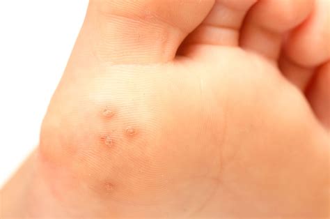 Warts Types Symptoms Causes Treatment And More
