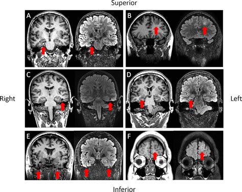 Brain Imaging In Epilepsy Practical Neurology