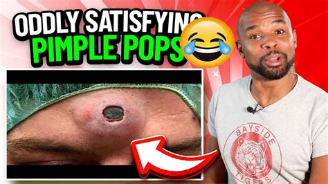 Disgusting But Satisfying Pimple Zit Popping Compilation Part 10 Youtube