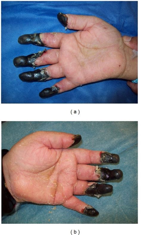 Bilateral Peripheral Gangrene Of Upper Extremities Open I