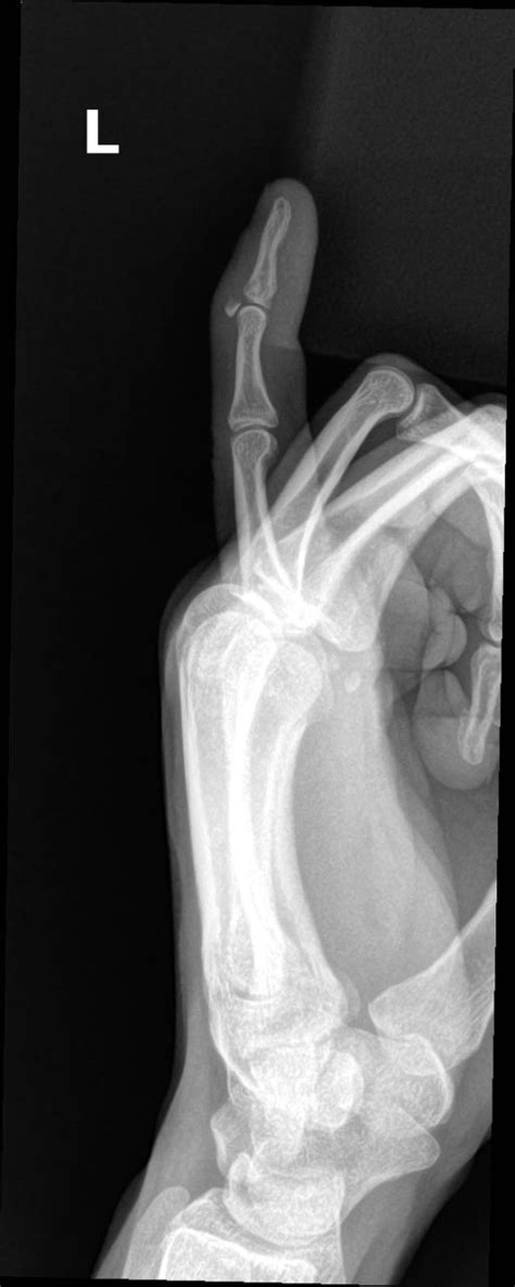 Orthodx Bony Mallet Finger Clinical Advisor