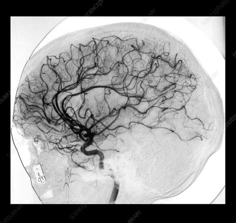 Cerebral Angiogram Stock Image F0319947 Science Photo Library
