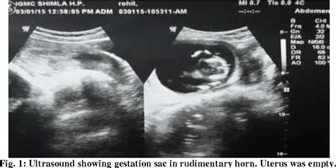 Figure From Unruptured Second Trimester Pregnancy In A Rudimentary