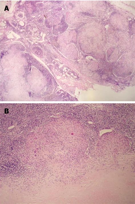 Figure 4 From Tuberculous Lymphadenitis As A Cause Of Obstructive
