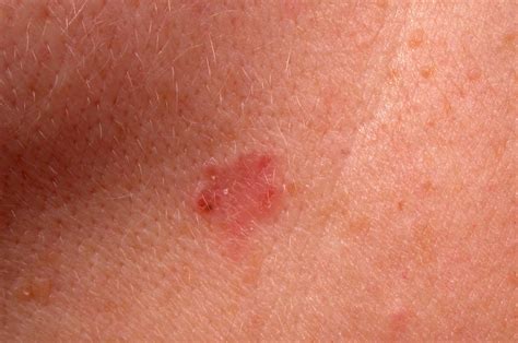 Early Stages Of Melanoma Skin Cancer