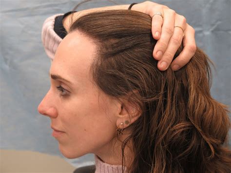Exegese Folge Planen Laser Hair Removal Widows Peak Geldgummi Peave Incubus