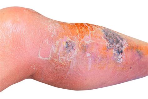 However, when it turns red, develop bumps, form blisters, or become intensely itchy the parameters have changed and you have developed a cellulitis rash. Sepsis Rash Stock Photos, Pictures & Royalty-Free Images - iStock