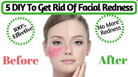 How To Get Rid Of Redness On Your Face Without Makeup Mugeek Vidalondon