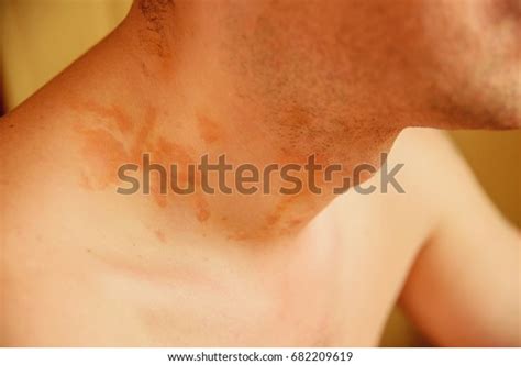 Allergic Skin Rash Spots On Neck Stock Photo 682209619 Shutterstock