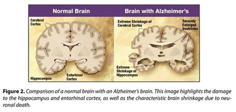 What Is The Difference Between Alzheimers And Dementia Medicaid