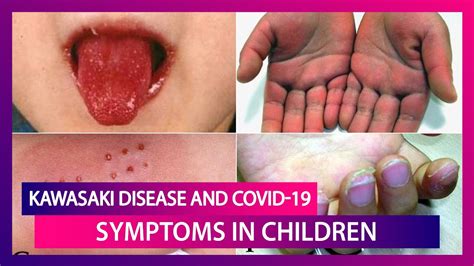 Is There A Link Between Covid 19 And Kawasaki Disease From Skin Rashes