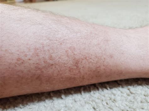 Brown Spots On Both Legs Rmedical