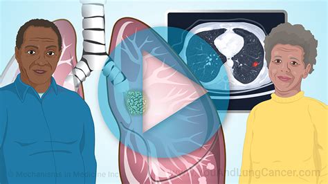 Animation Understanding Non Small Cell Lung Cancer