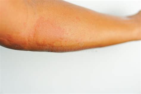 Eruzione Cutanea Intensa Di Allergia Su Pelle Sensibile Immagine Stock