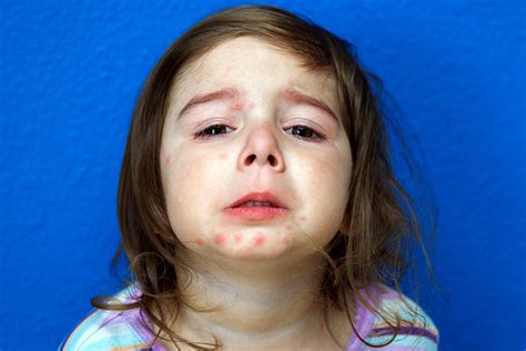 Psoriasis In Children Types Symptoms And Treatment