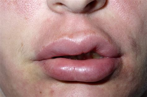 Angioedema Dermatology Conditions And Treatments