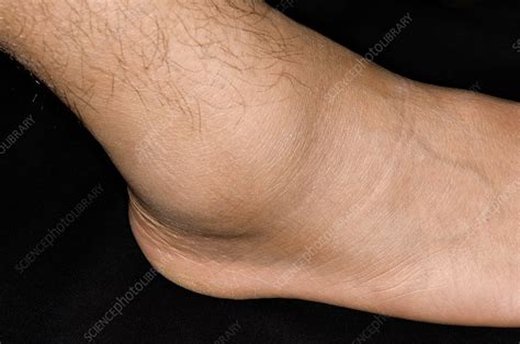 Sprained Ankle Sports Injury Stock Image C0090028 Science Photo