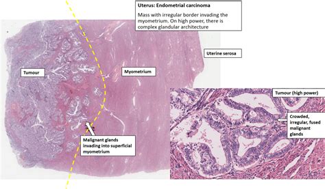 Uterus Endometrial Carcinoma Nus Pathweb