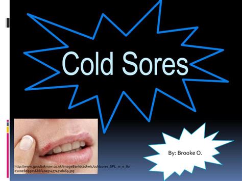 Ppt Cold Sores Powerpoint Presentation Free Download Id6531561