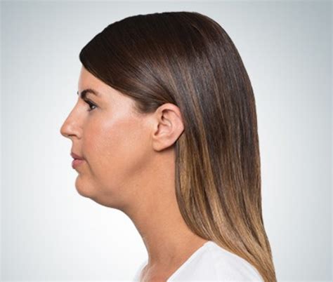 Kybella Injection Double Chin Reduction Top Dc Plastic Surgeons