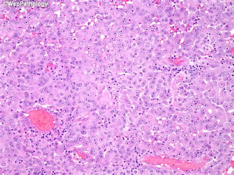 Peritoneal mesothelioma develops in the abdomen after asbestos exposure. Webpathology.com: A Collection of Surgical Pathology Images