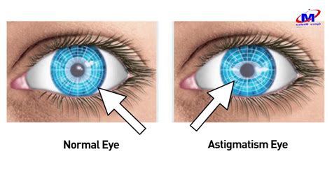 Astigmatismo Definicion Wikipedia Astigmatism Glaucoma Swollen Eyes