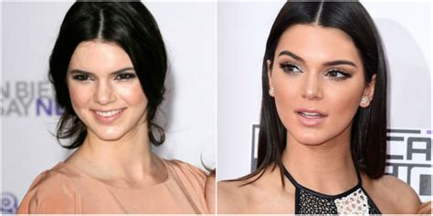 Cirugías De Kendall Jenner Antes Y Después Cirugias De