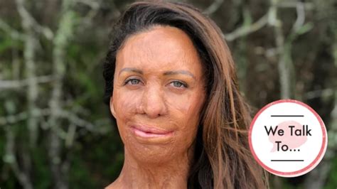 Turia Pitt I Lost Friends After The Fire And It Hurt Body Soul