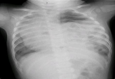 Radiology Image Spotters Congenital Diaphragmatic Hernia