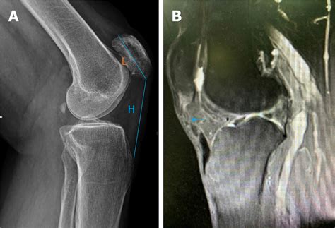 Ligament Augmentation Reconstruction System Artificial Ligaments In