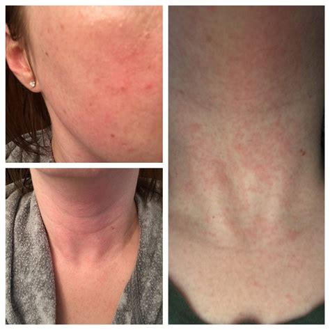 Skin Concerns Itchy Hive Y Rash On Mostly Neck Some Face Reaction To Clinique Moisturizers