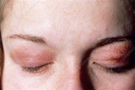 Allergic Reaction To Eye Make Up Stock Image M3200018 Science