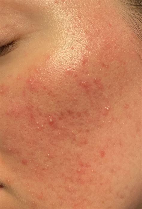 Skin Concern Allergic Reaction Or Acne Details In Comments Racne
