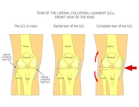 Lateral Collateral Ligament Injury Physio Treatment Toronto