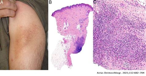 Granulomas In Dermatopathology Principal Diagnoses Part 1 Actas