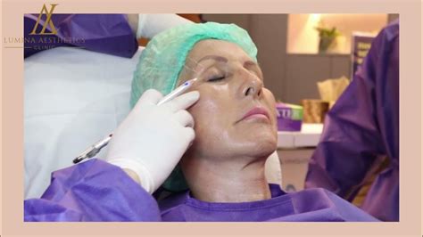 Thread Lift Or Filler Photo Before And After Lumina Aesthetics Clinic Youtube