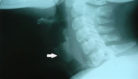 Thyroid Cartilage X Ray