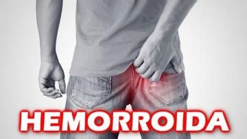 Hemorroida O Que Causas Sintomas E Tratamentos Buscar Sa De
