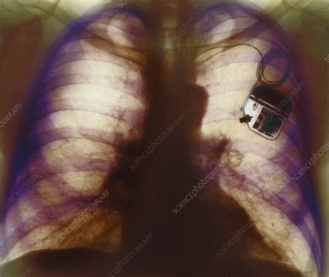 Heart Pacemaker X Ray Stock Image M5000039 Science Photo Library